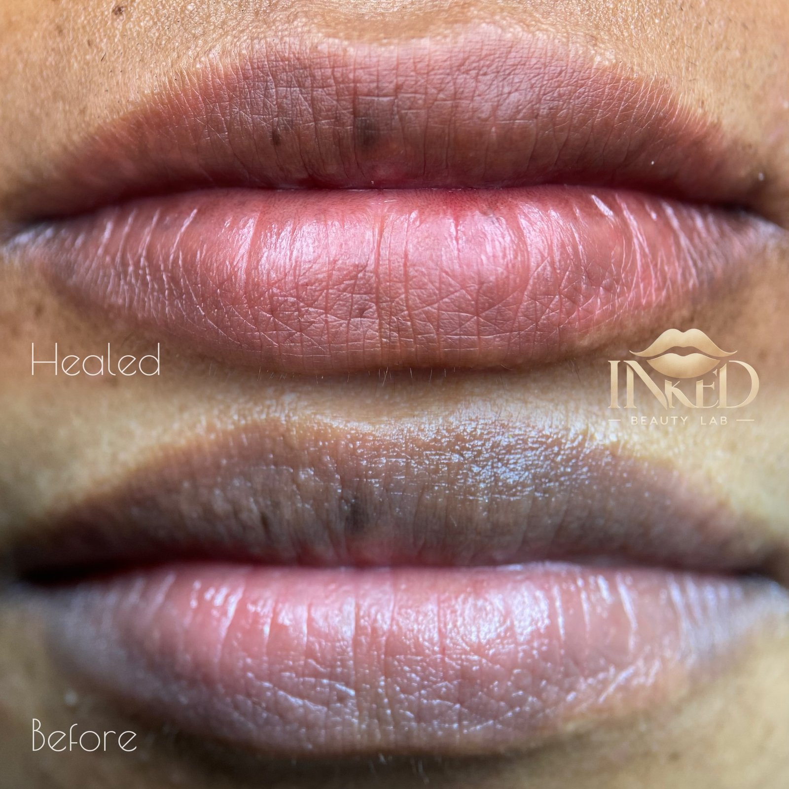 Lip neutralisation result